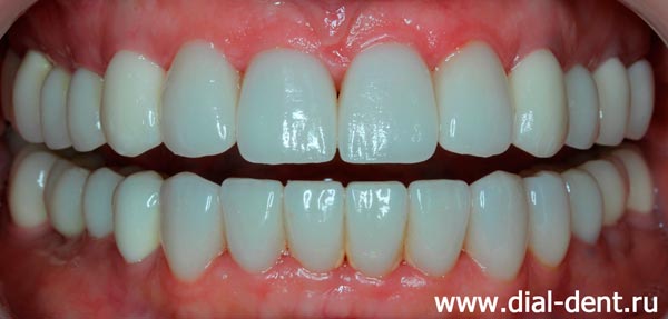 изменен цвет и форма зубов, каждый зуб восстановлен отдельной коронкой, отсутствующие зубы спротезированы на имплантах
