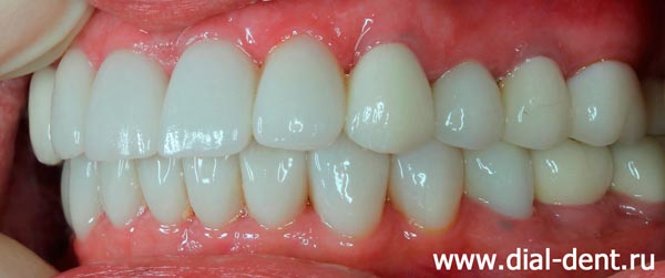 вид зубов после протезирования в Диал-Дент