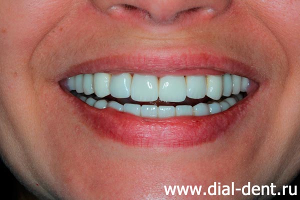 улыбка после лечения и протезирования зубов в Диал-Дент