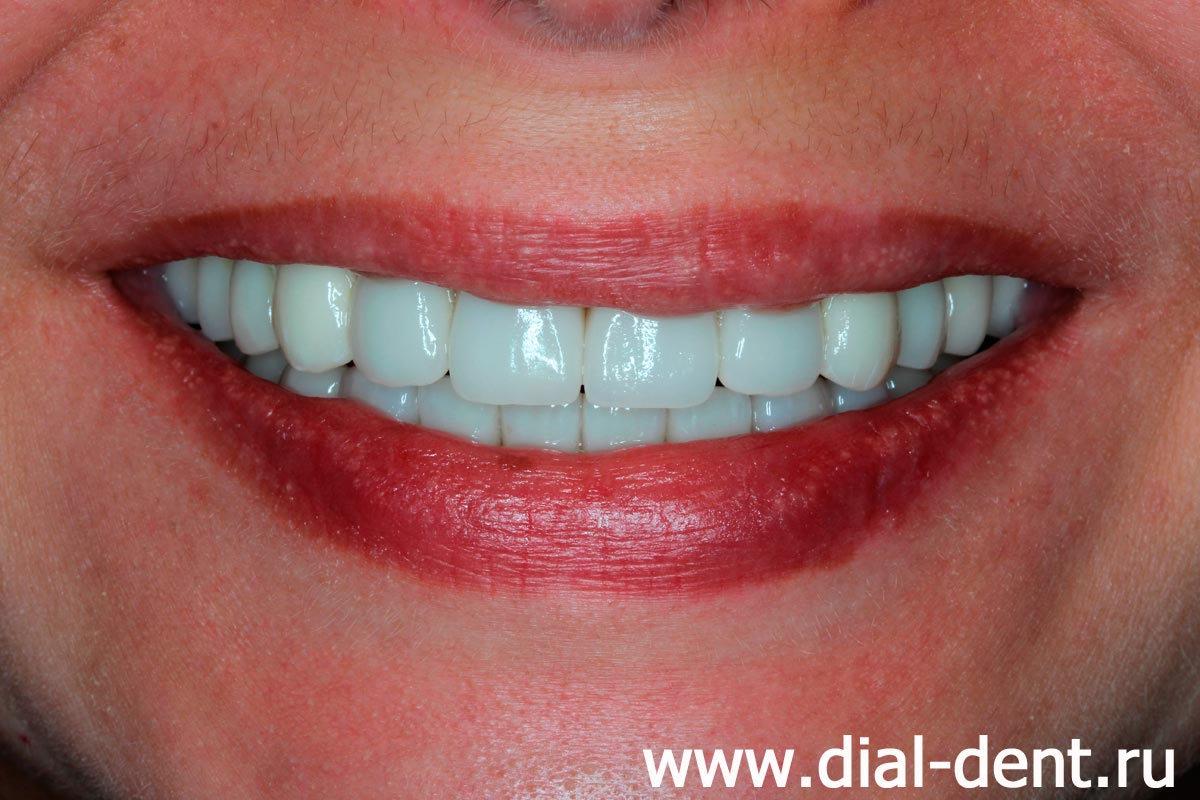 улыбка после проведенного комплексного лечения и протезирования зубов