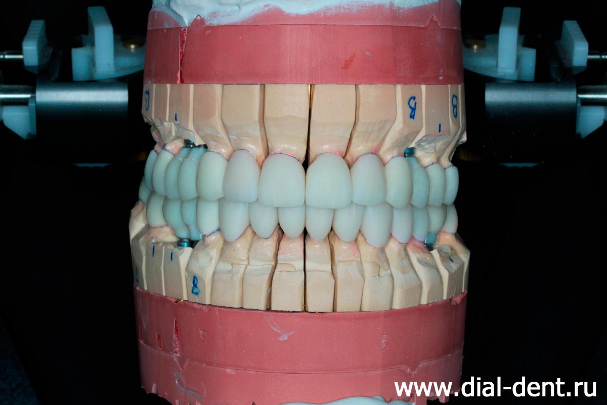 моделирование зубных коронок в Диал-Дент с использованием артикулятора