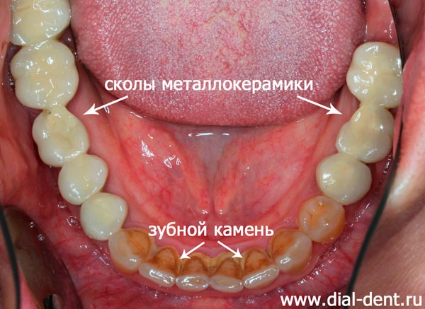 нижние зубы до протезирования, одного зуба нет
