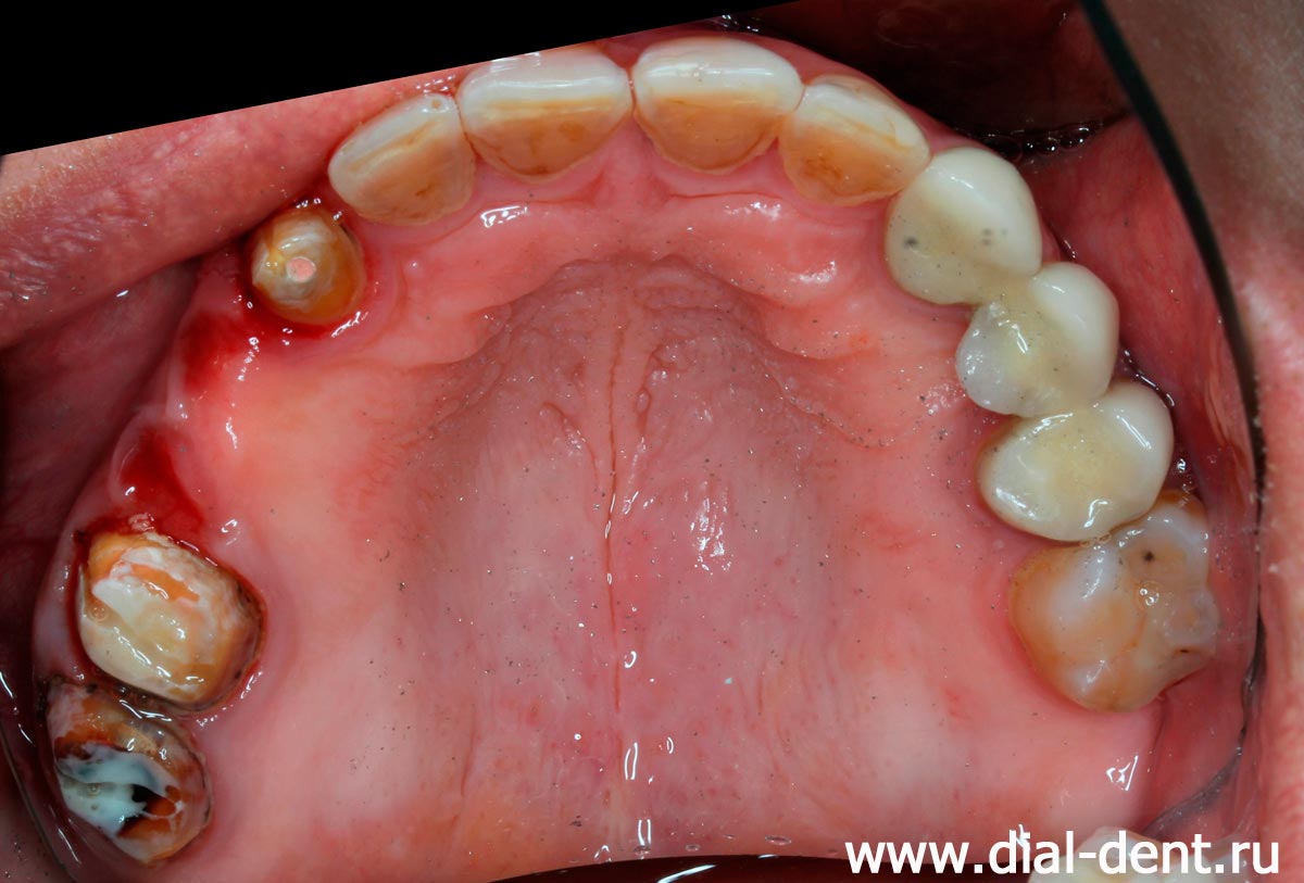 после удаления старого мостовидного протеза на верхней челюсти видно воспаление десны под протезом, разрушенные опорные зубы