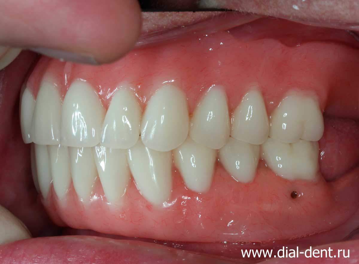 зубные протезы при отсутствии зубов