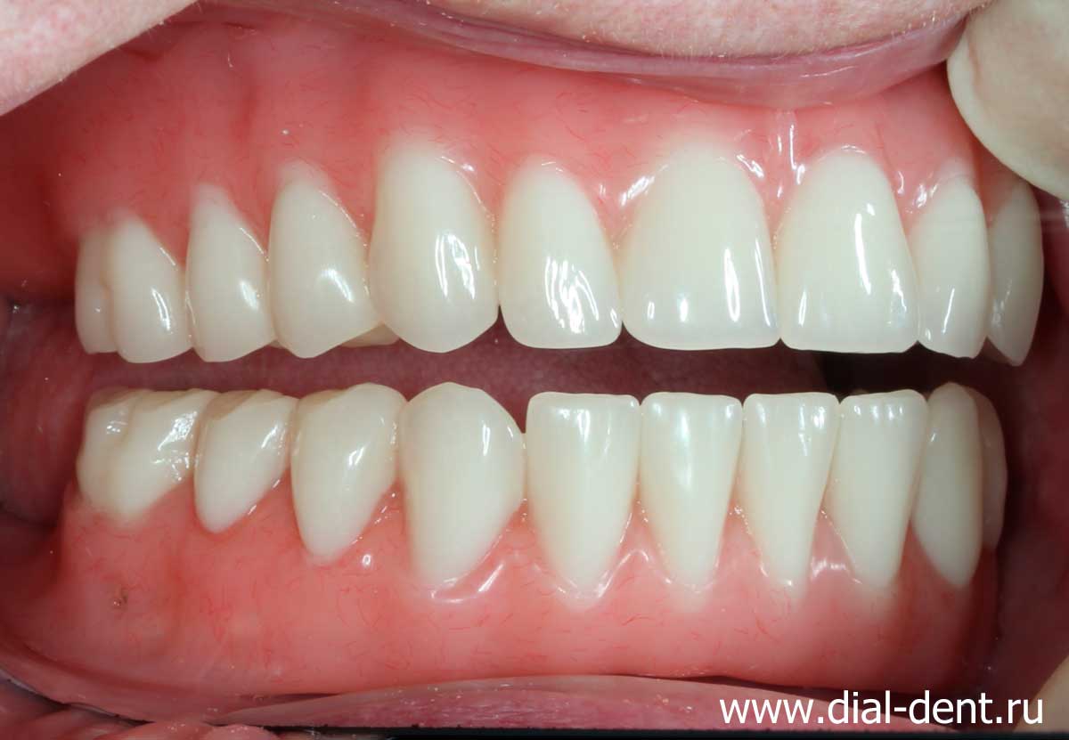зубные протезы при отсутствии зубов