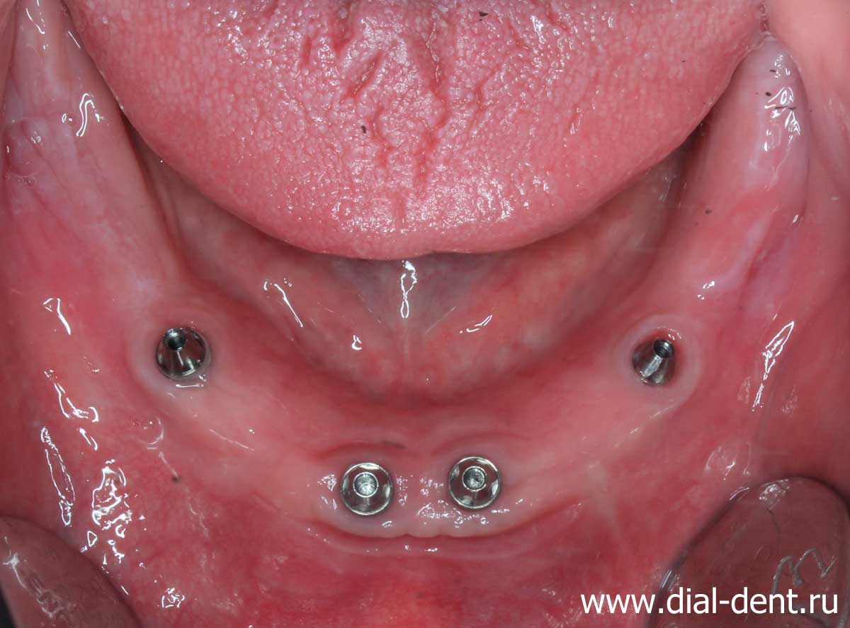 имплантация зубов на Павелецкой в Диал-Дент
