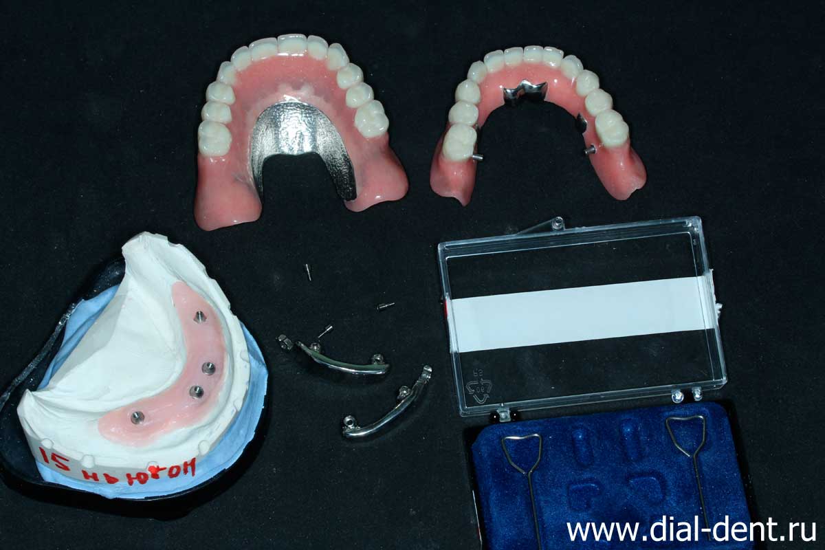 полные зубные протезы от Диал-Дент