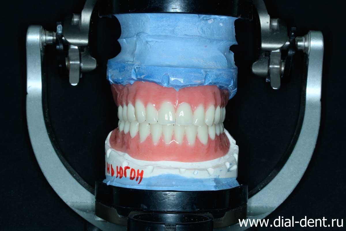 изготовление полных зубных протезов в Диал-Дент