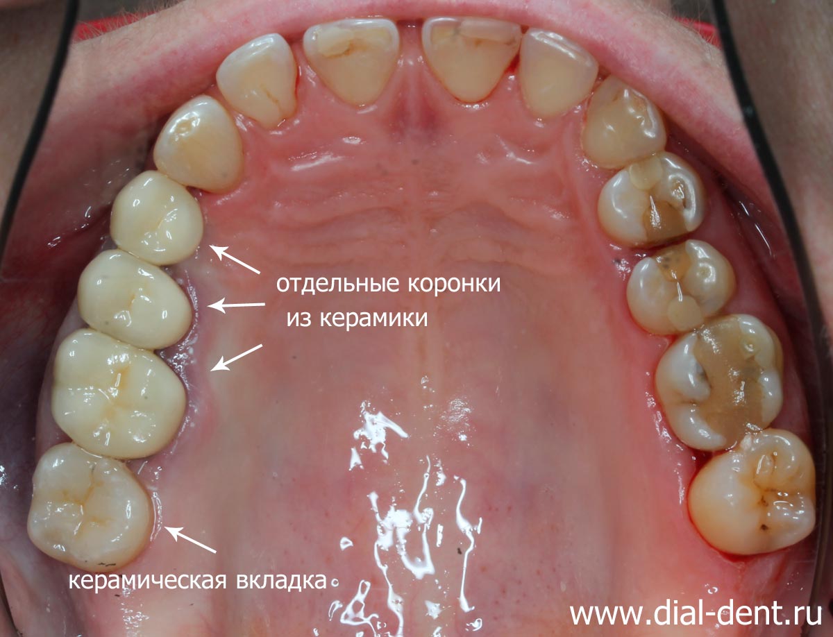 результат первого этапа протезирования зубов