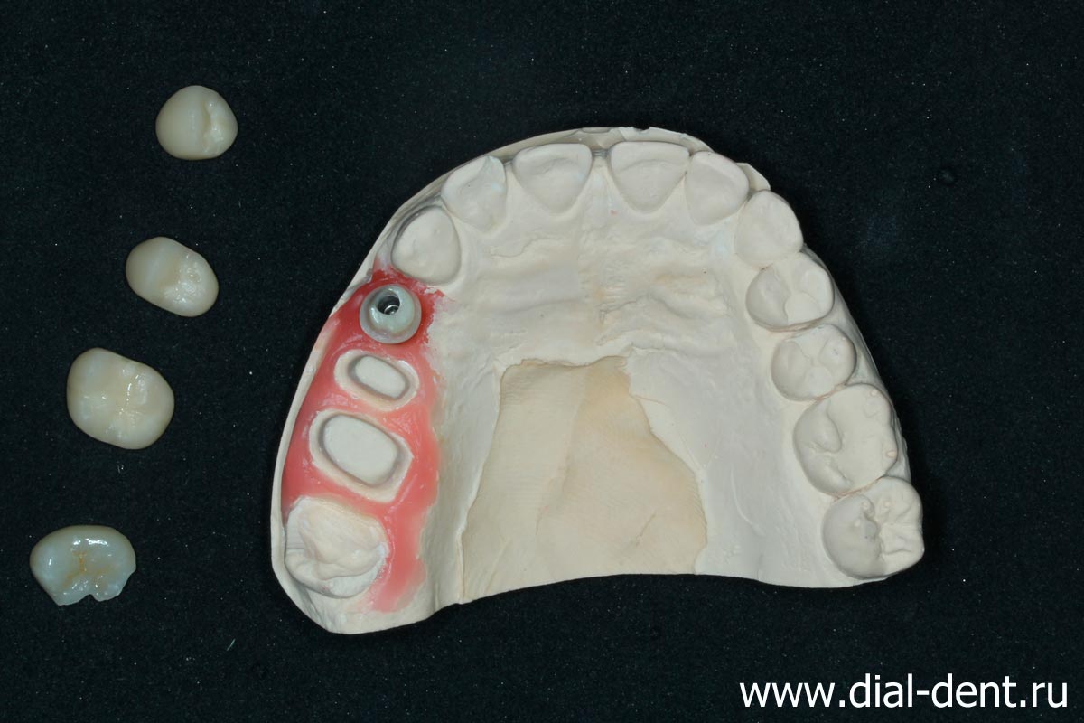 керамические коронки, протезирование на импланте, керамическая вкладка в зуб