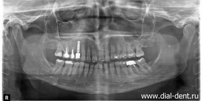 панорамный снимок зубов после первого этапа лечения и протезирования