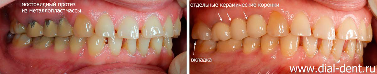протезирование зубов керамикой
