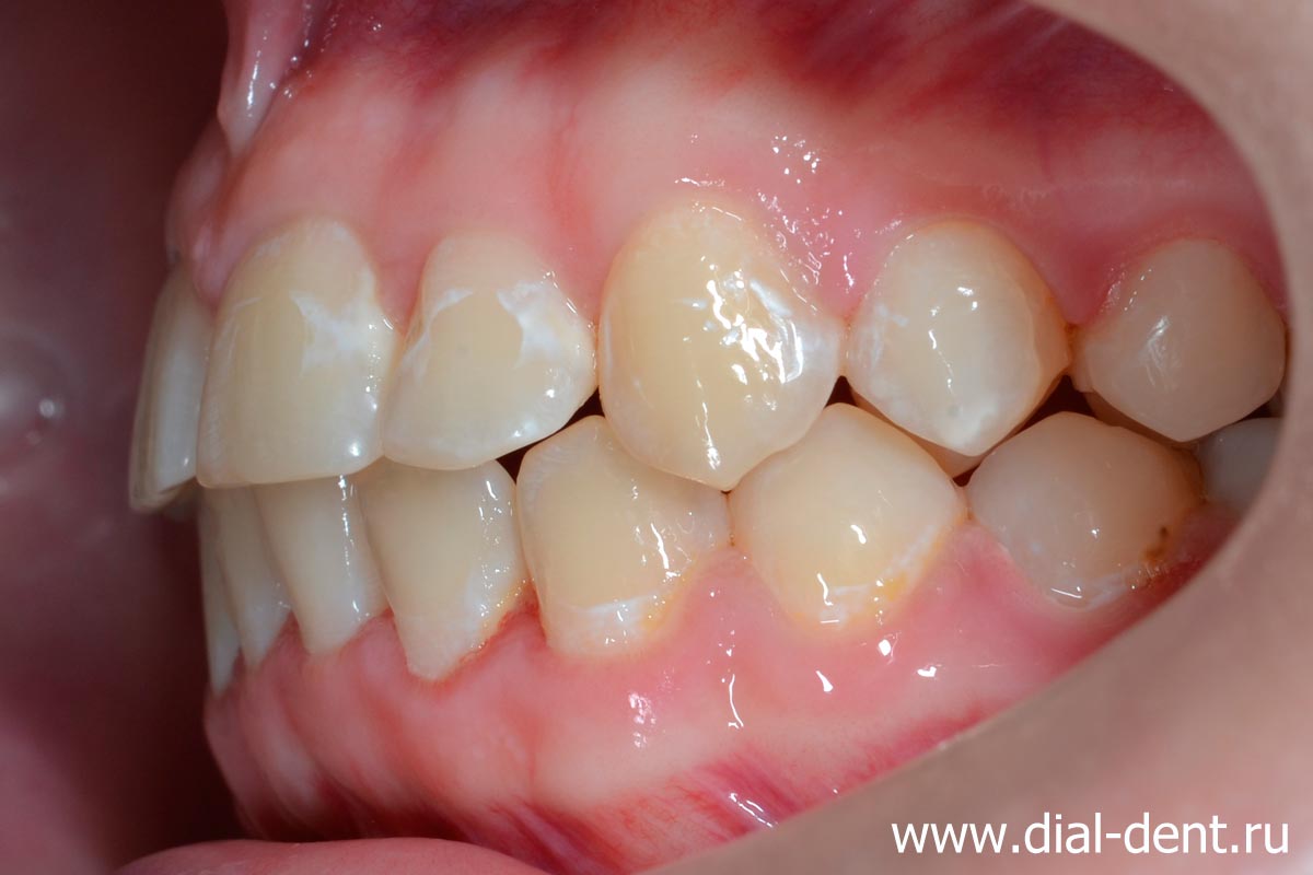 результат ортодонтического лечения - ровные зубы