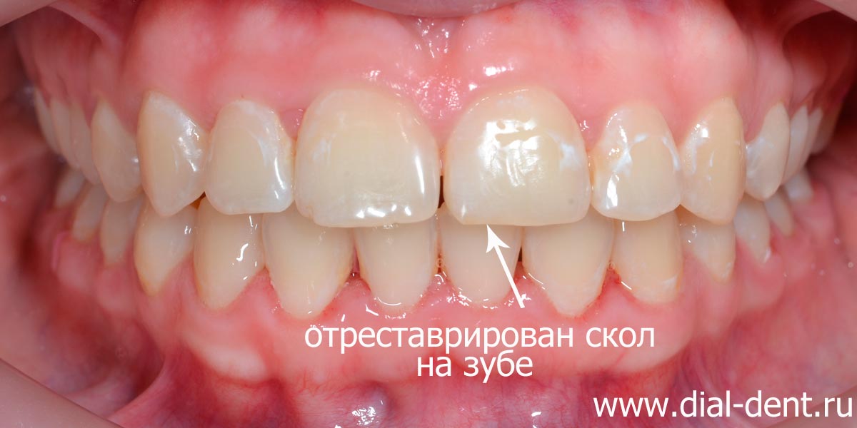 результат комплексного лечения: выровнены зубы, устранен скол переднего зуба