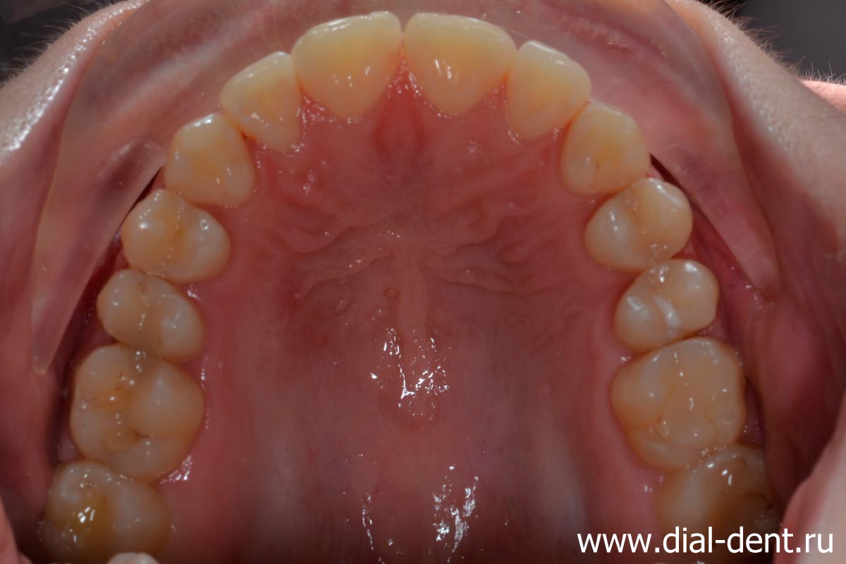 результат ортодонтического лечения - ровные зубы