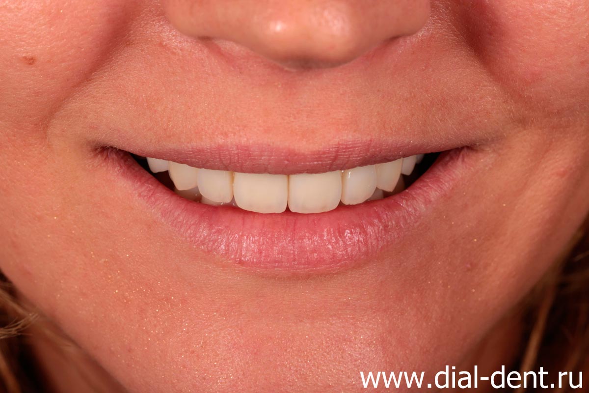 реставрация передних зубов и комплексное лечение от специалистов Диал-Дент