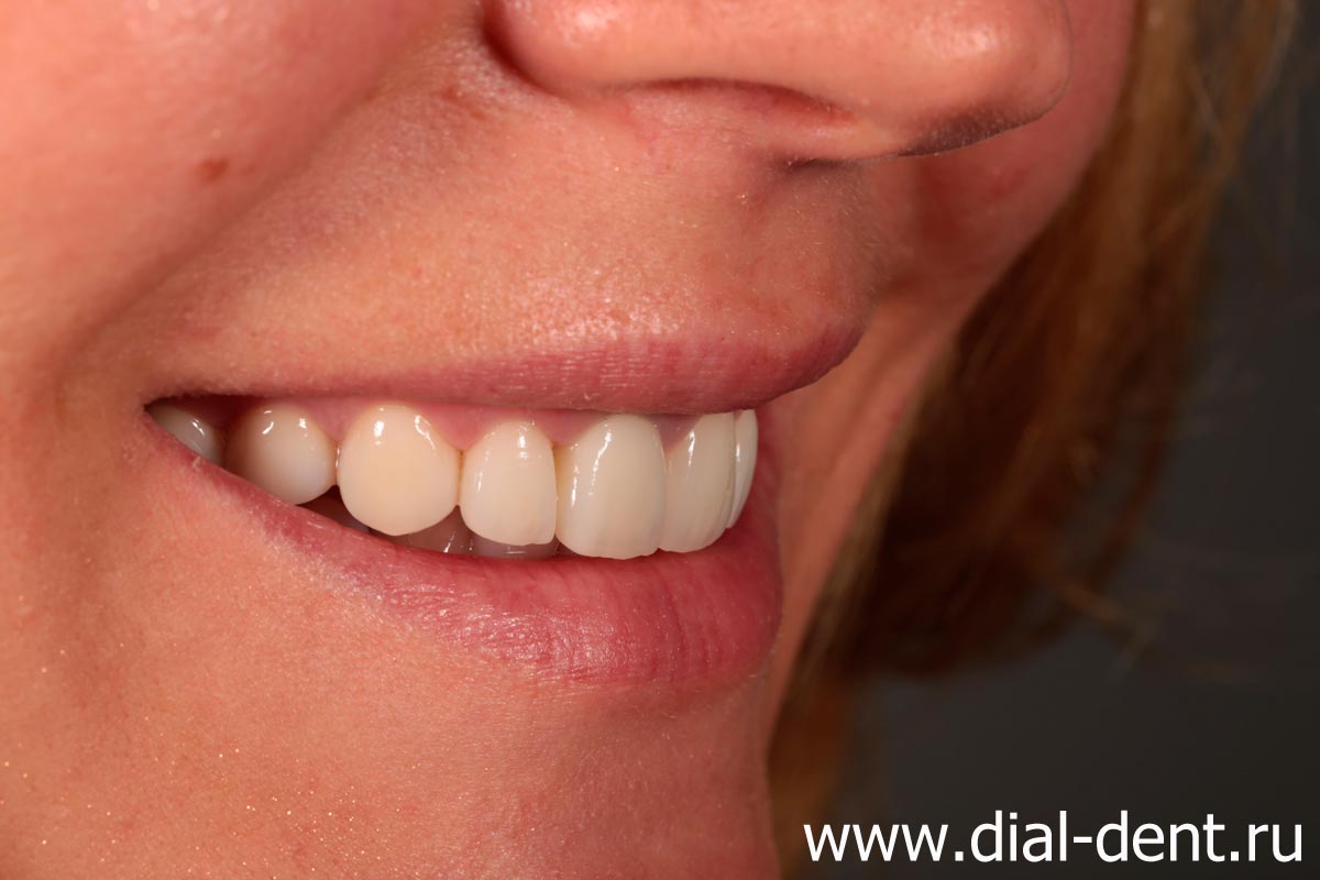 результат комплексного лечения и протезирования зубов в Диал-Дент