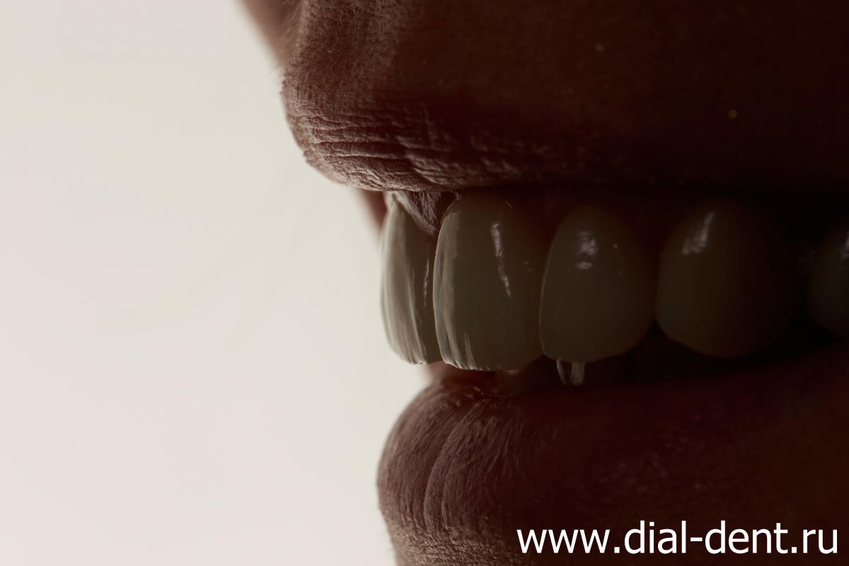 эстетичное протезирование зубов в Диал-Дент