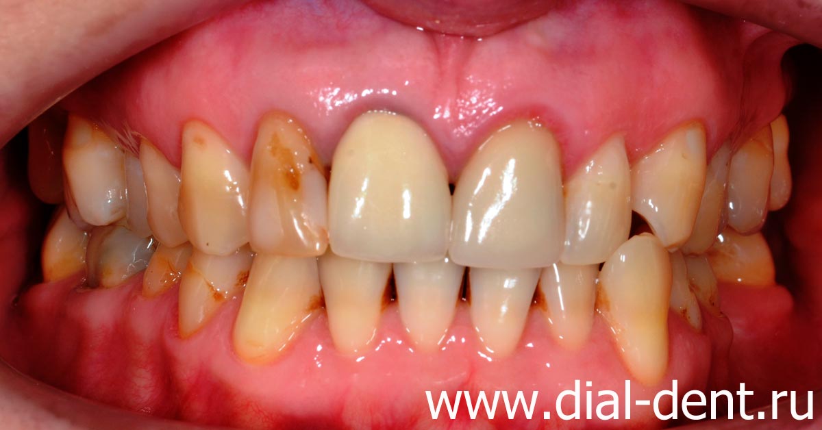 вид зубов до лечения: зубы растут криво, старые реставрации, желтый цвет, старые металлокерамические коронки на передних зубах