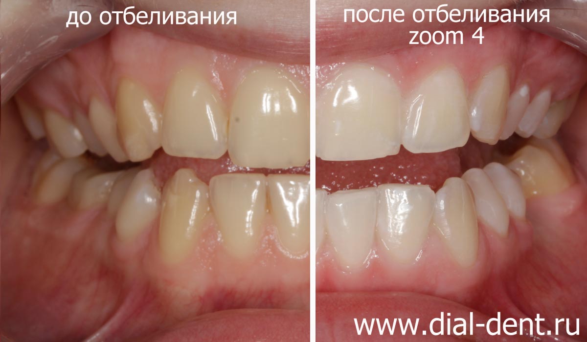 ZOOM 4 отбеливание зубов в Диал-Дент