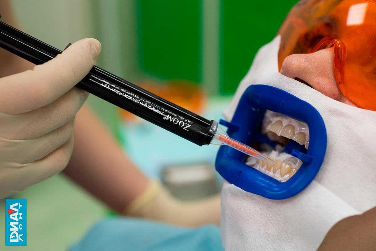 отбеливание зубов в клинике Диал-Дент