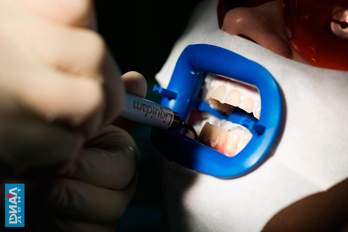 отбеливание зубов в клинике Диал-Дент на Павелецкой