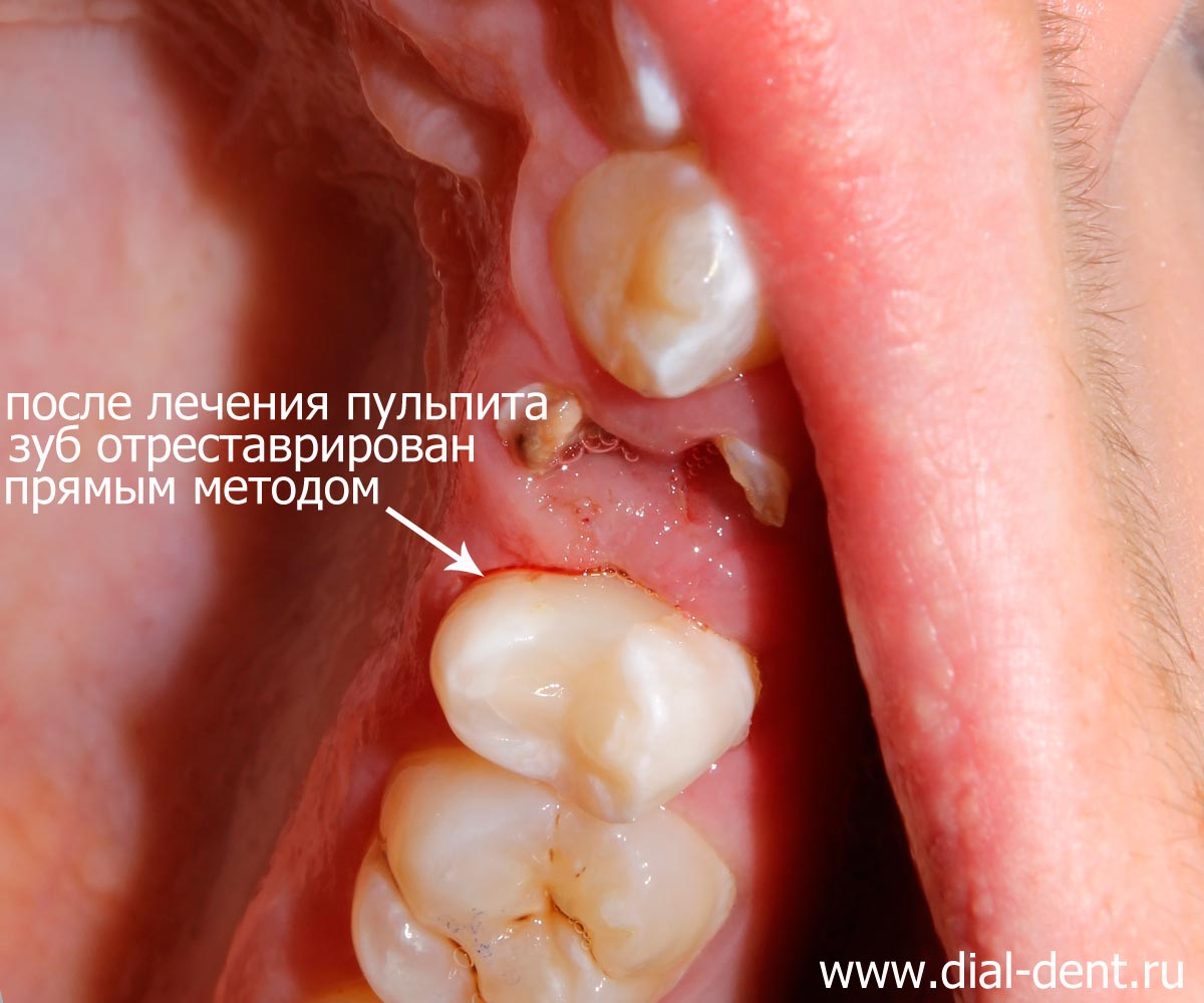 реставрация зуба выполнена композитом после лечения каналов