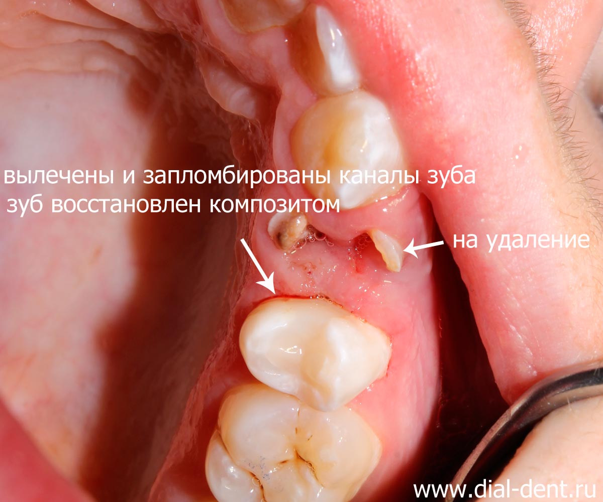 зуб отреставрирован после лечения пульпита