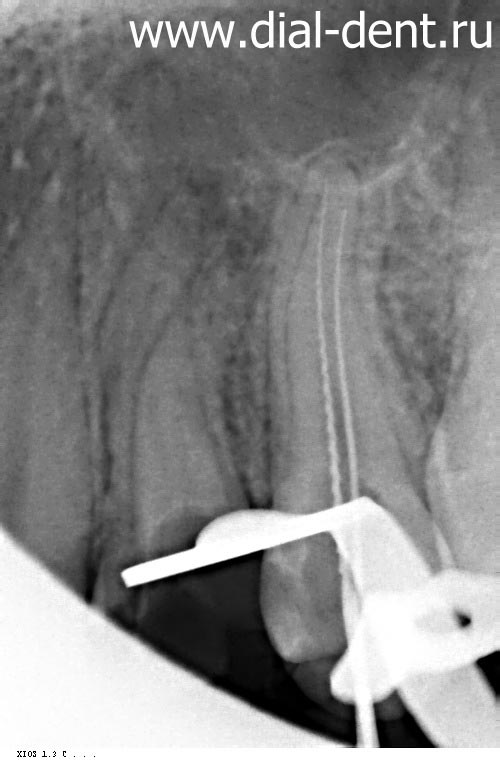 измерение каналов зуба