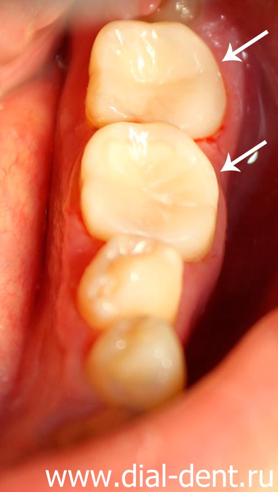 вид отреставрированных композитом зубов
