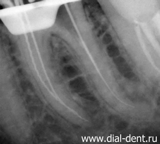 измерение длины каналов зуба