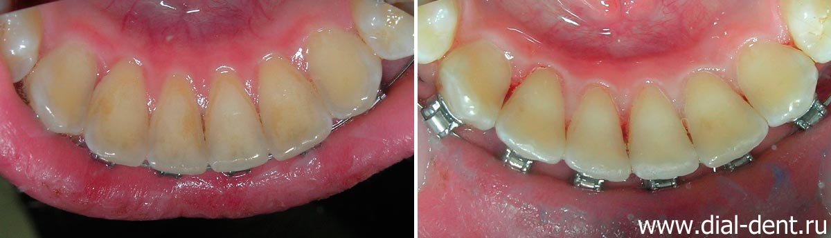 внутренняя поверхность нижних зубов до и после профессиональной чистки зубов