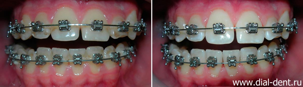 фото зубов с брекетами до и после профессиональной чистки зубов