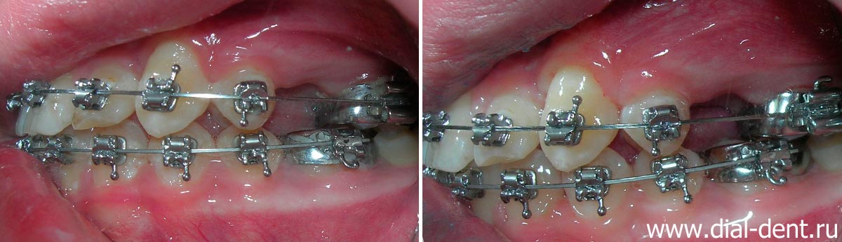 зубы слева до и после профессиональной чистки зубов