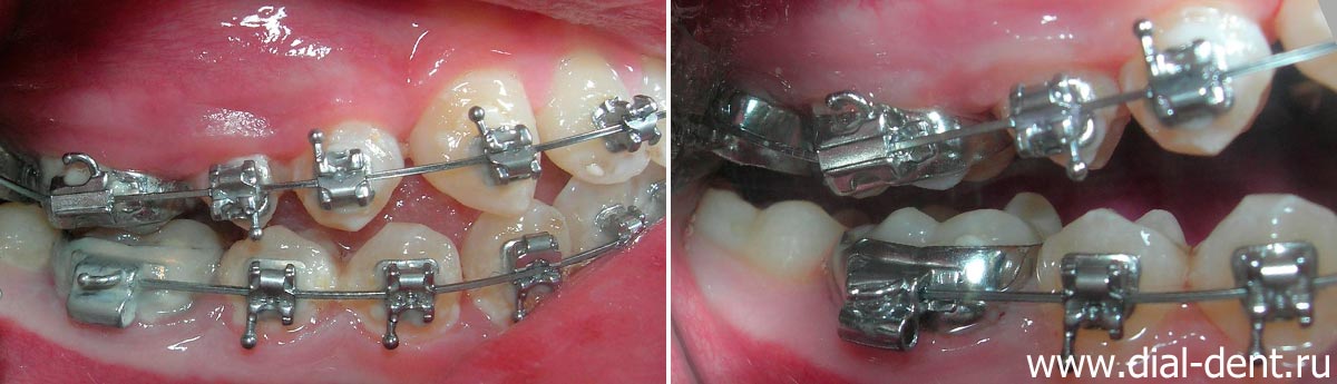 зубы справа до и после профессиональной чистки зубов
