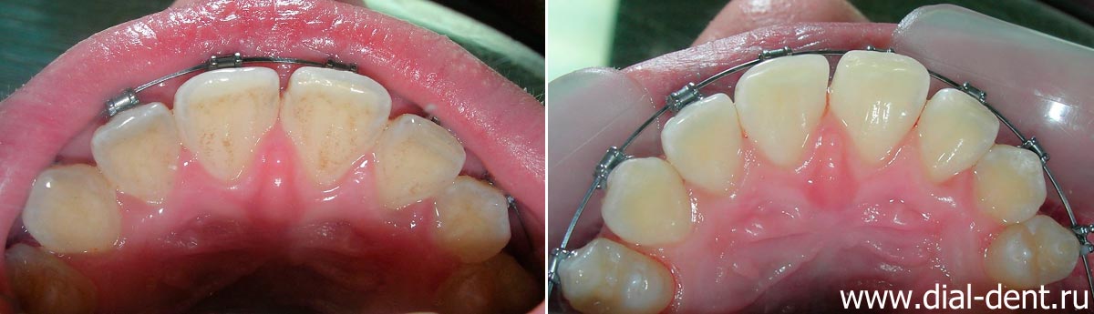 внутренняя поверхность верхних зубов до и после профессиональной чистки зубов