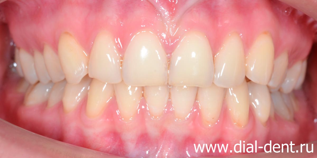 исходное состояние зубов - неправильный прикус, желтые зубы, сколотые края передних зубов