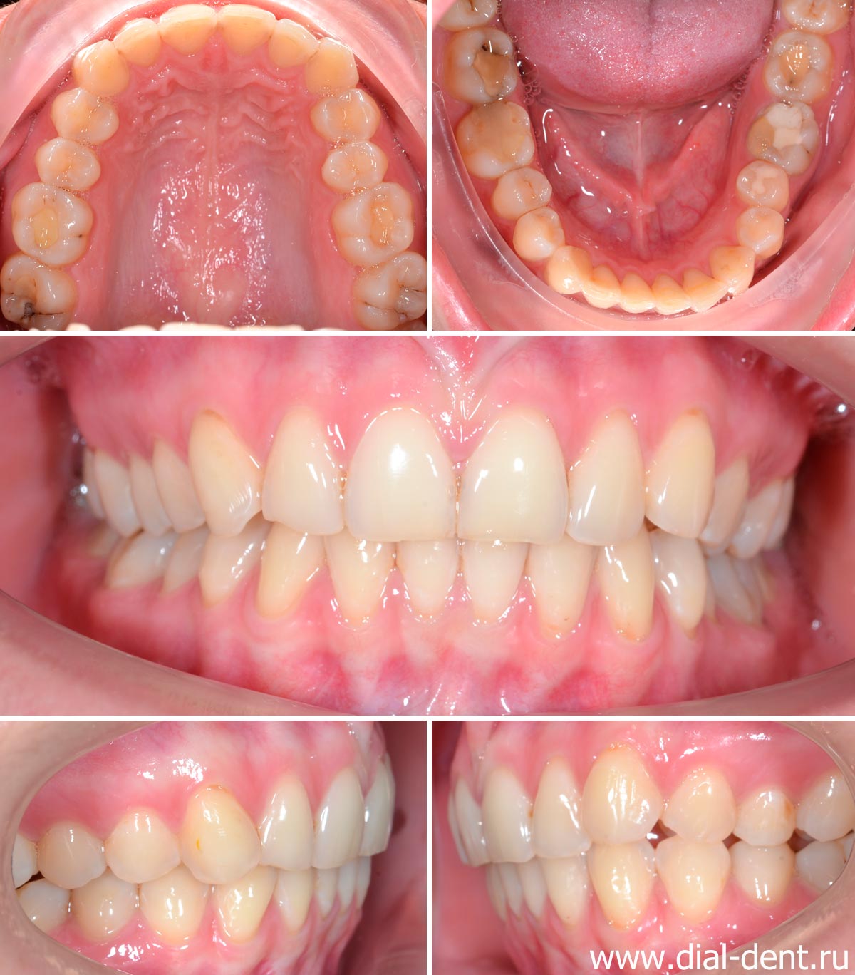 фотографии зубов для диагностики и составления плана лечения