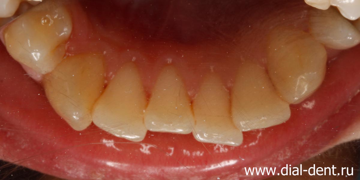 внутренняя поверхность зубов после профессиональной чистки