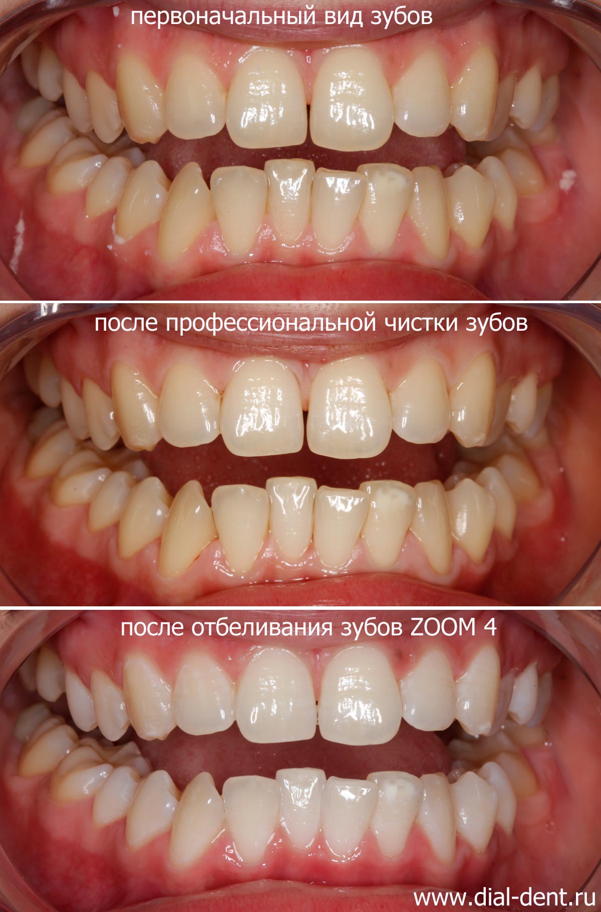 вид зубов при обращении, после чистки и после отбеливания
