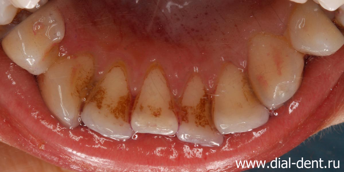 много зубного налета и зубного камня на внутренней поверхности зубов