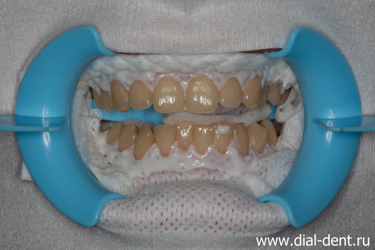 изоляция губ и десен перед отбеливанием зубов