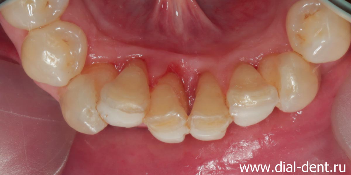 выполнена профессиональная чистка зубов в Диал-Дент, очищены внутренние поверхности зубов от зубного камня
