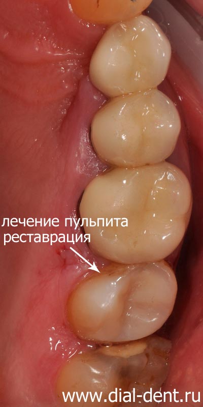 лечение пульпита, реставрация зуба композитом (протезирование отложено)