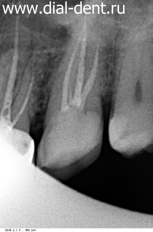 рентген зуба для контроля пломбировки каналов 