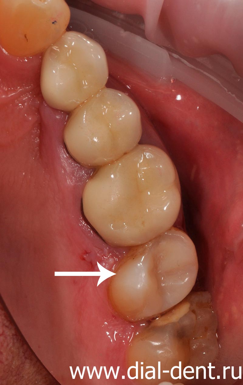 проведено лечение пульпита, зуб отреставрирован композитом