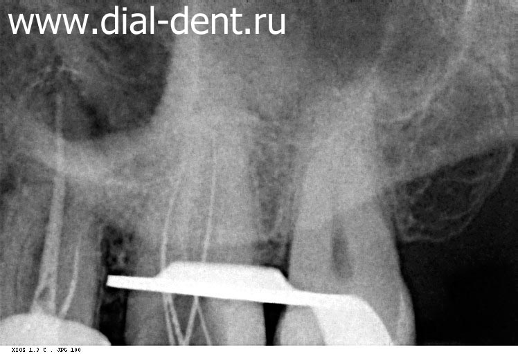 рентген зуба для измерения точной длины каналов