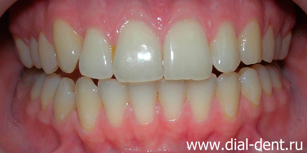 после лечения брекетами зубы ровные, но цвет не нравится пациентке