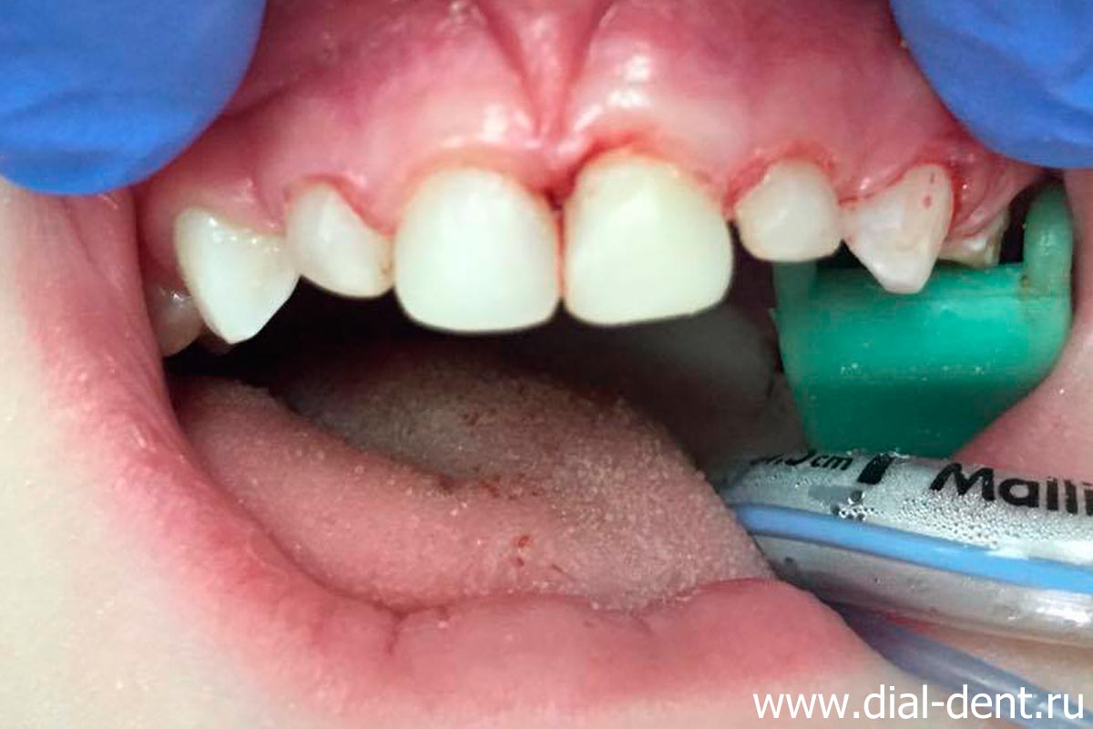проведено лечение молочных зубов под наркозом, передние зубы отреставрированы светоотверждаемым материалом