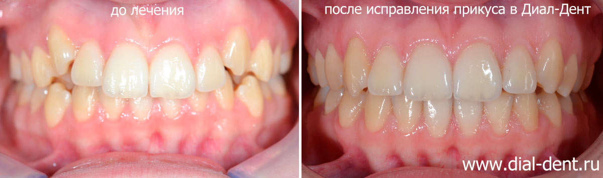 вид зубов до и после лечения